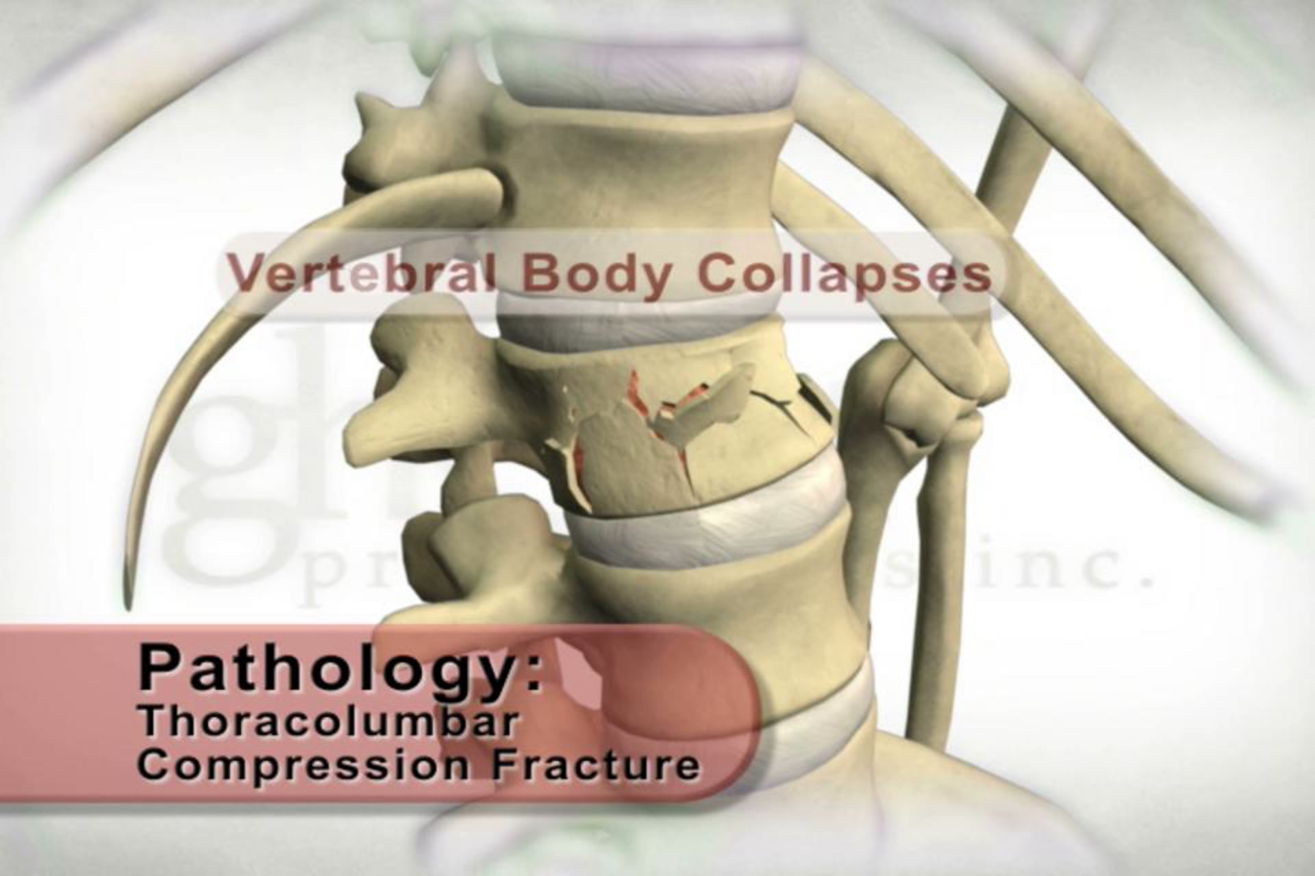 Thoracolumbar Compression Fracture