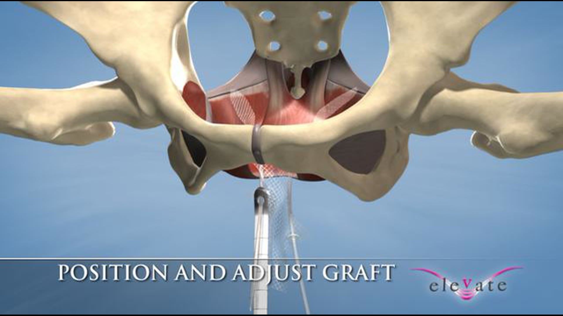 3D Urology Video - Medical Animation Reel - Ghost Productions