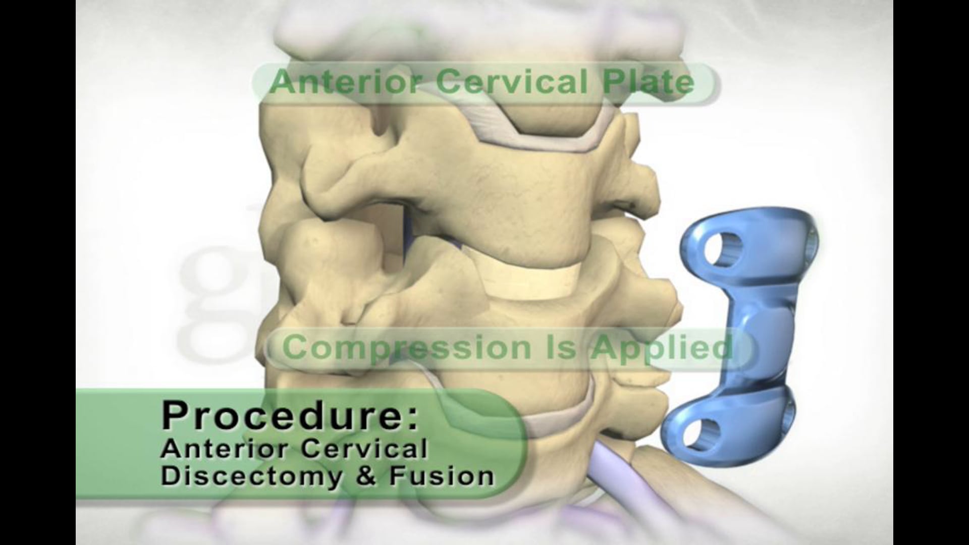 Ghost Productions - Procedure - Anterior Cervical Fusion