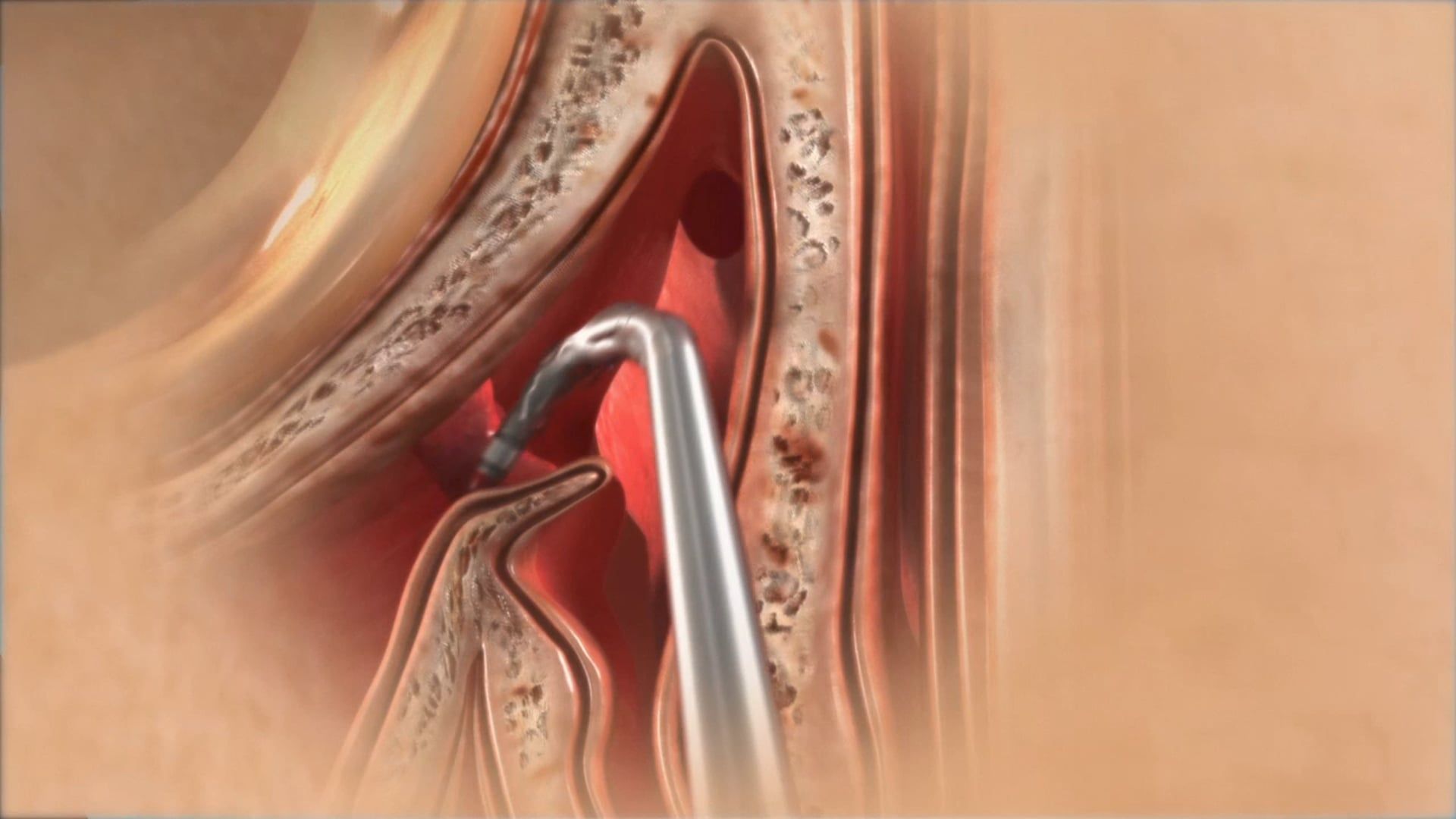 Medtronic: NuVent Sinus Dilation System
