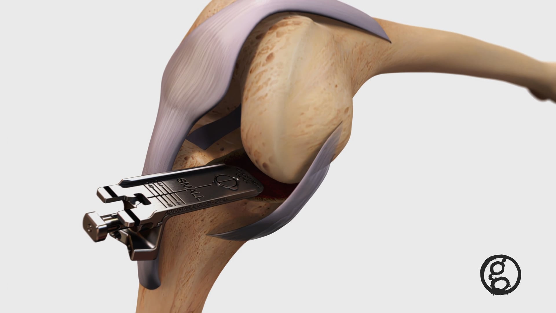 Ghost Productions - Zimmer Biomet Mirror™ Partial Knee Replacement