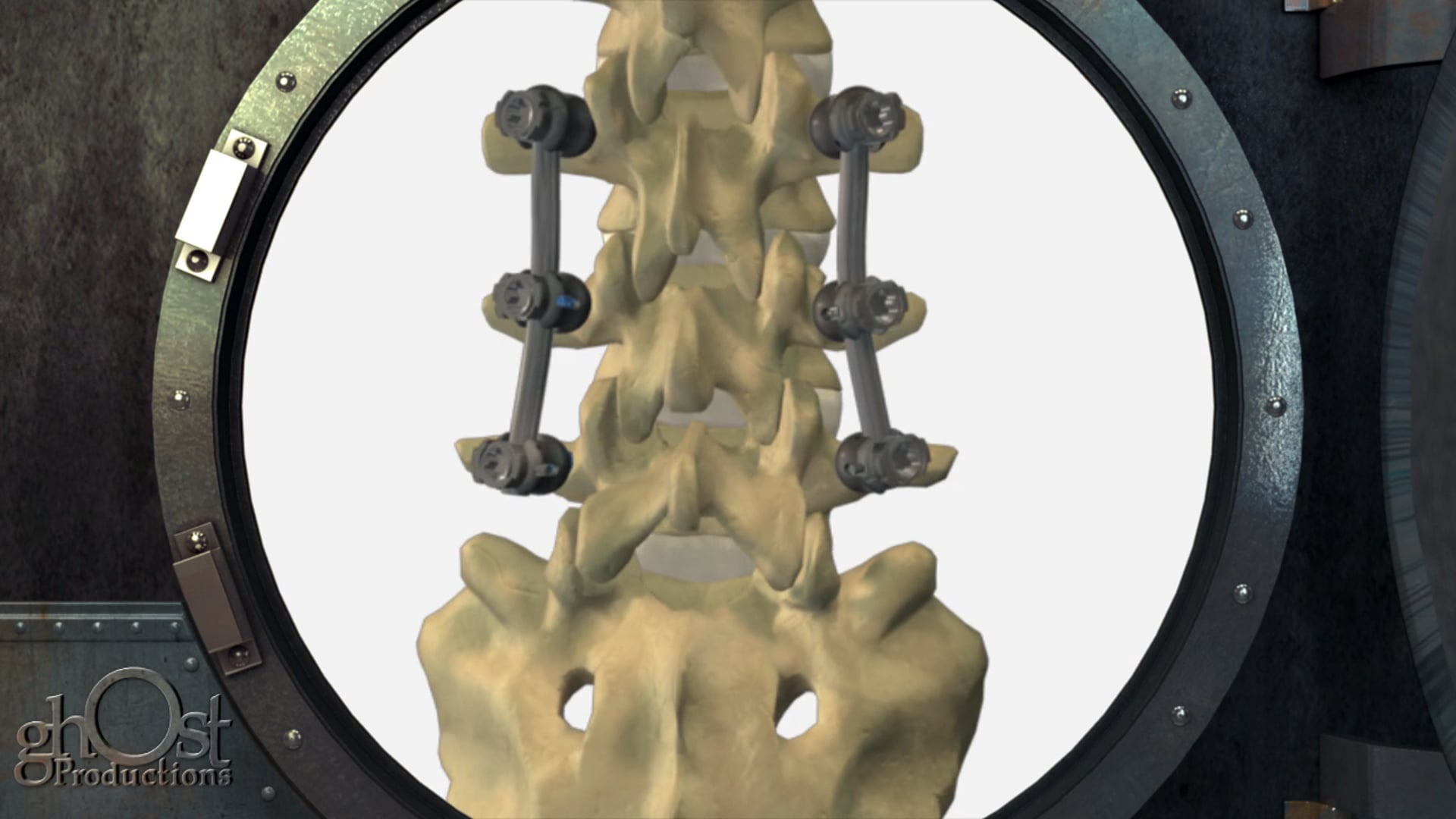 Innovative Spinal Technologies Paramount pedicle screw system