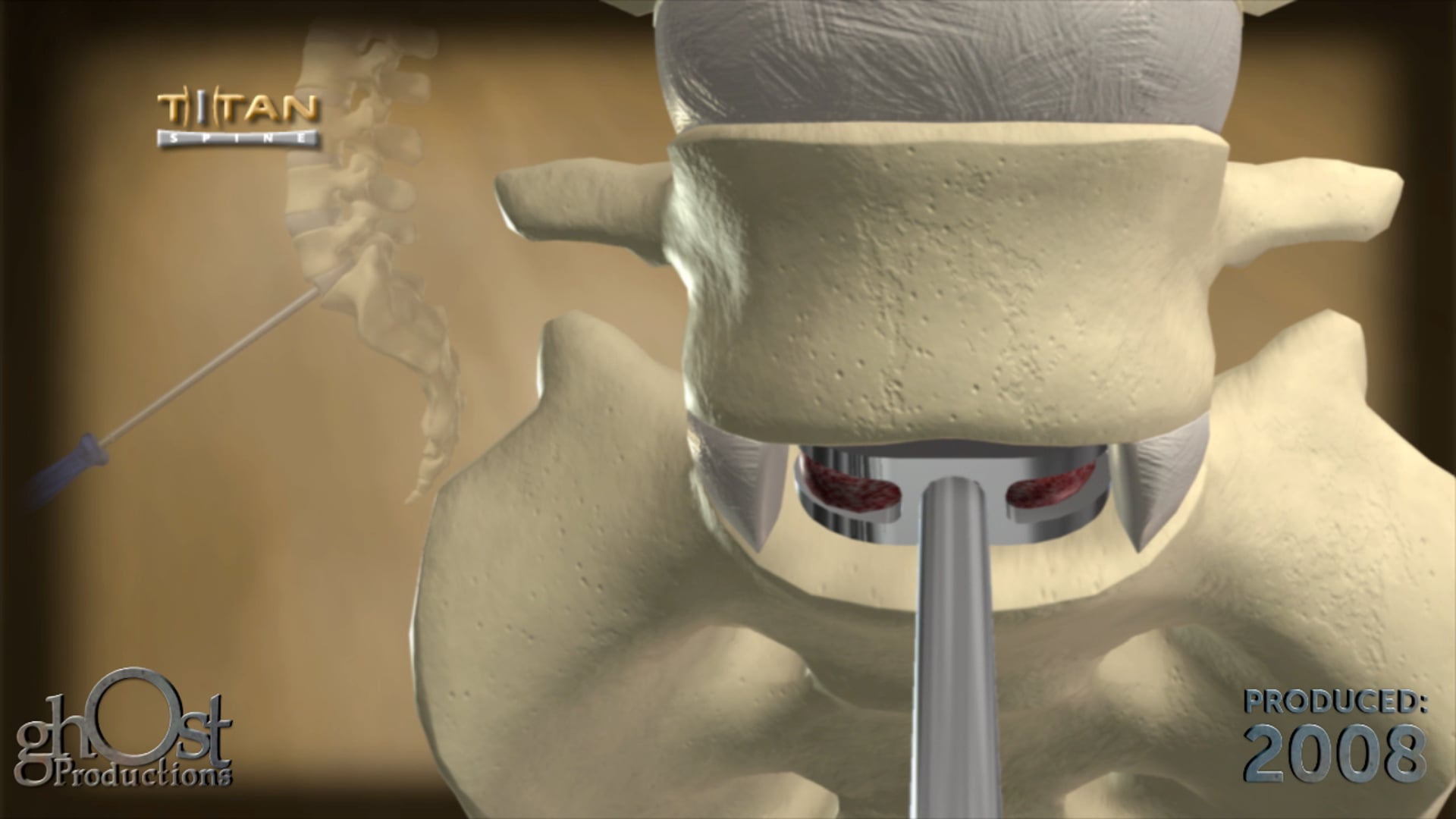 Titan Spine Endoskeleton